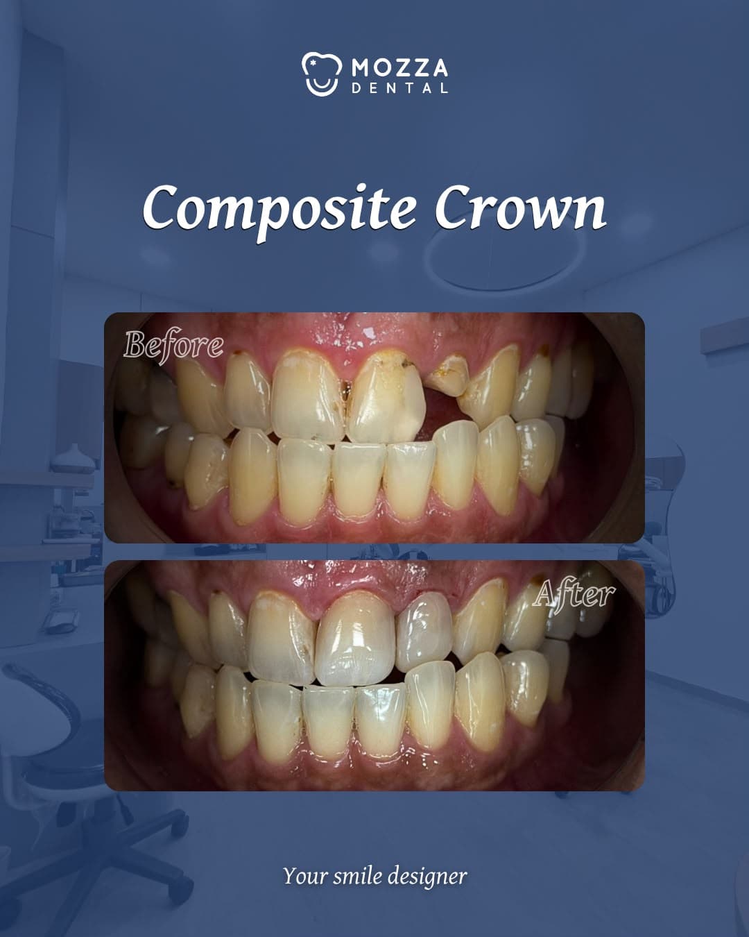 Composite Crown Case