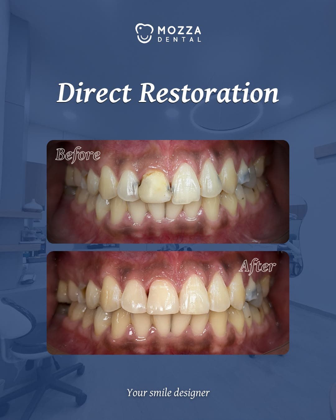 Direct Restoration (Tambal Gigi Estetik)