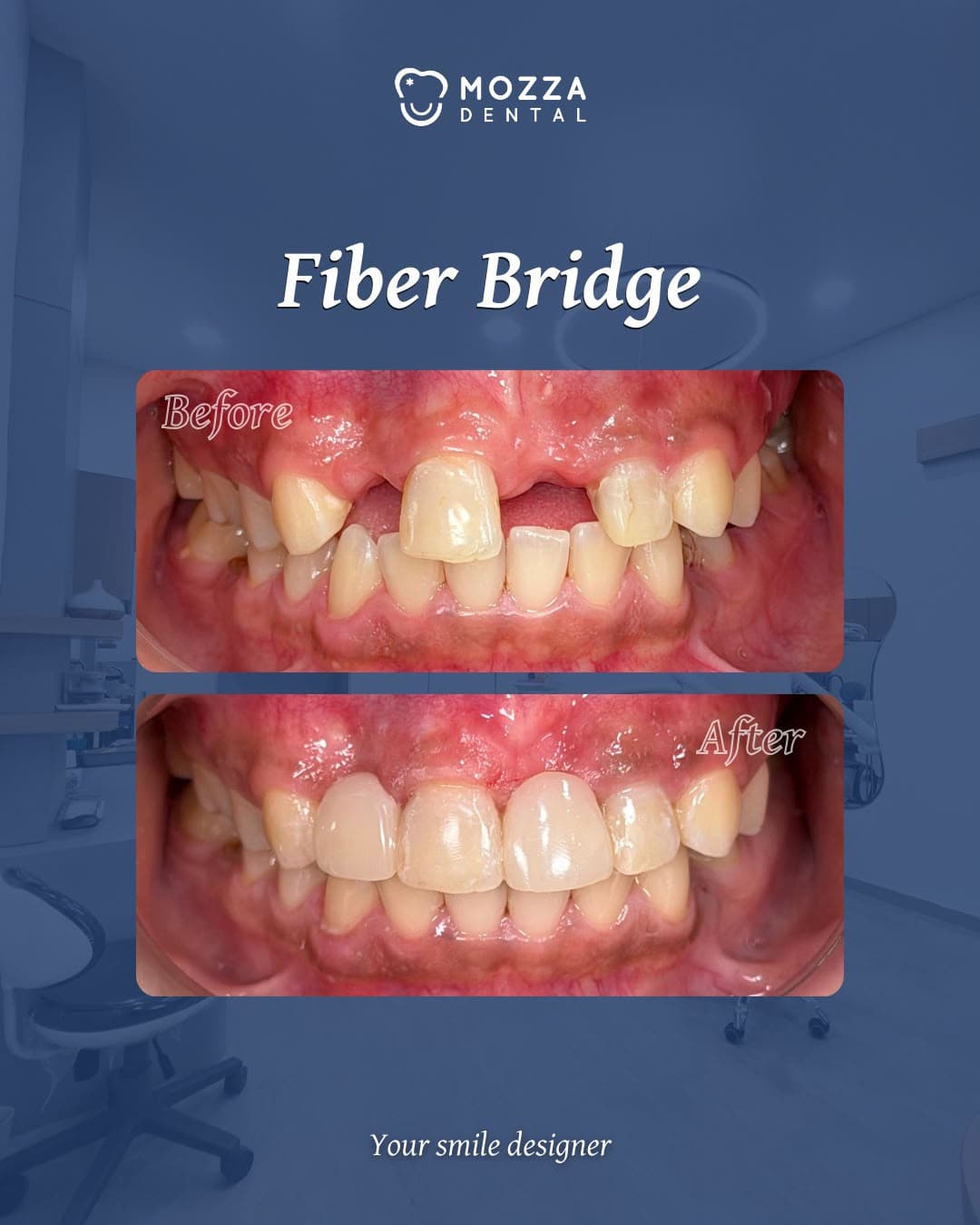 Fiber Bridge Case 1