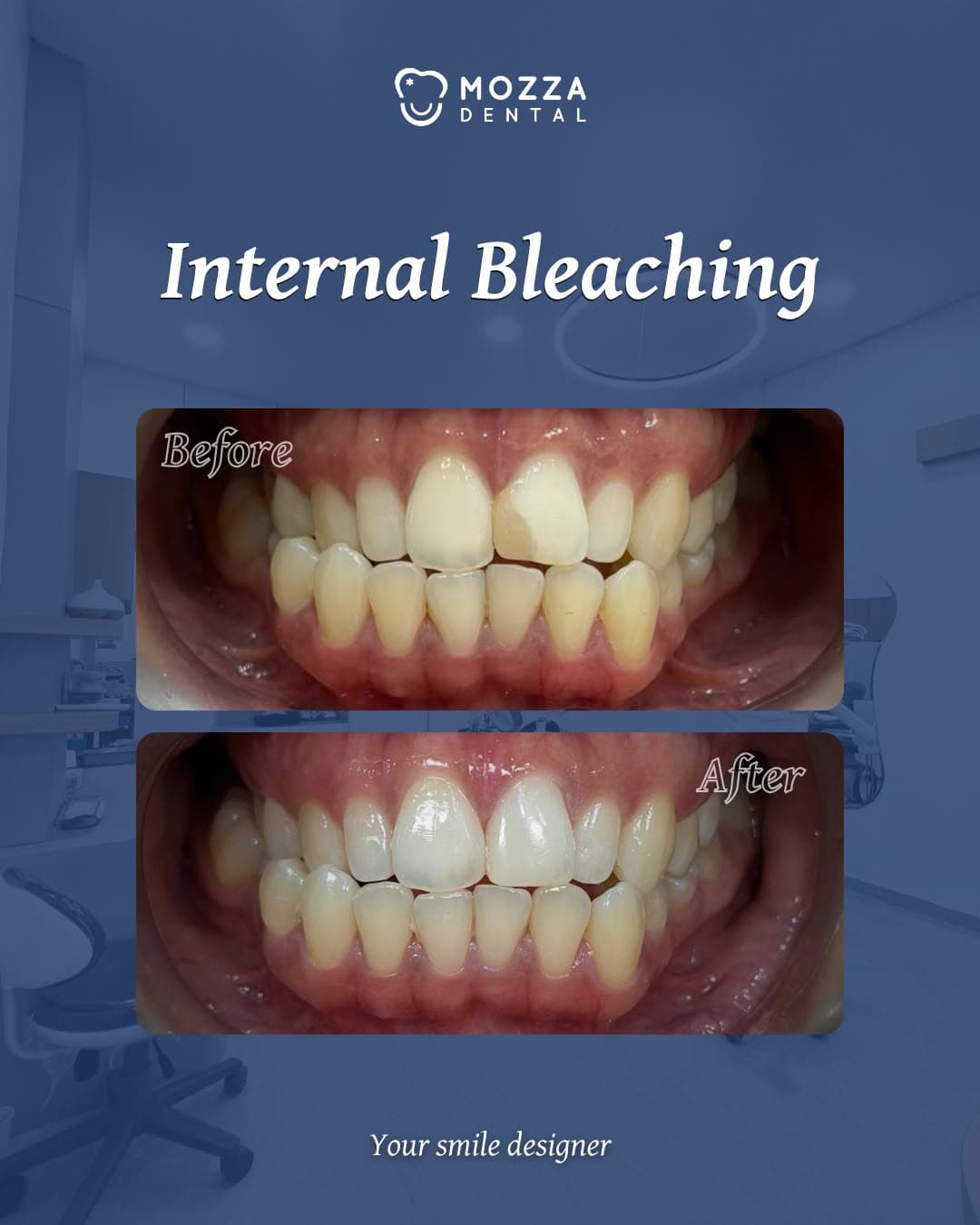 Internal Bleaching Gigi Mati