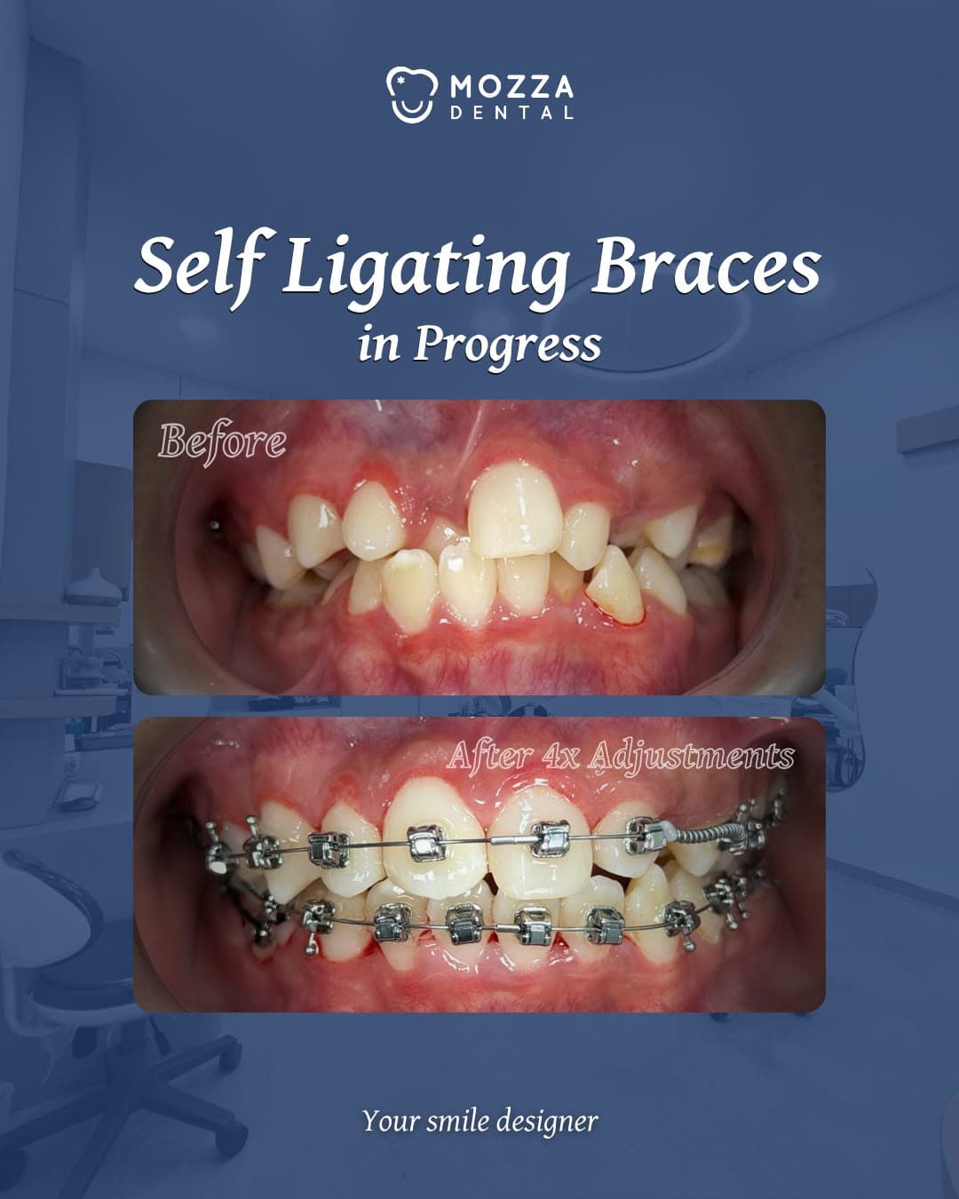 Self-Ligating Braces