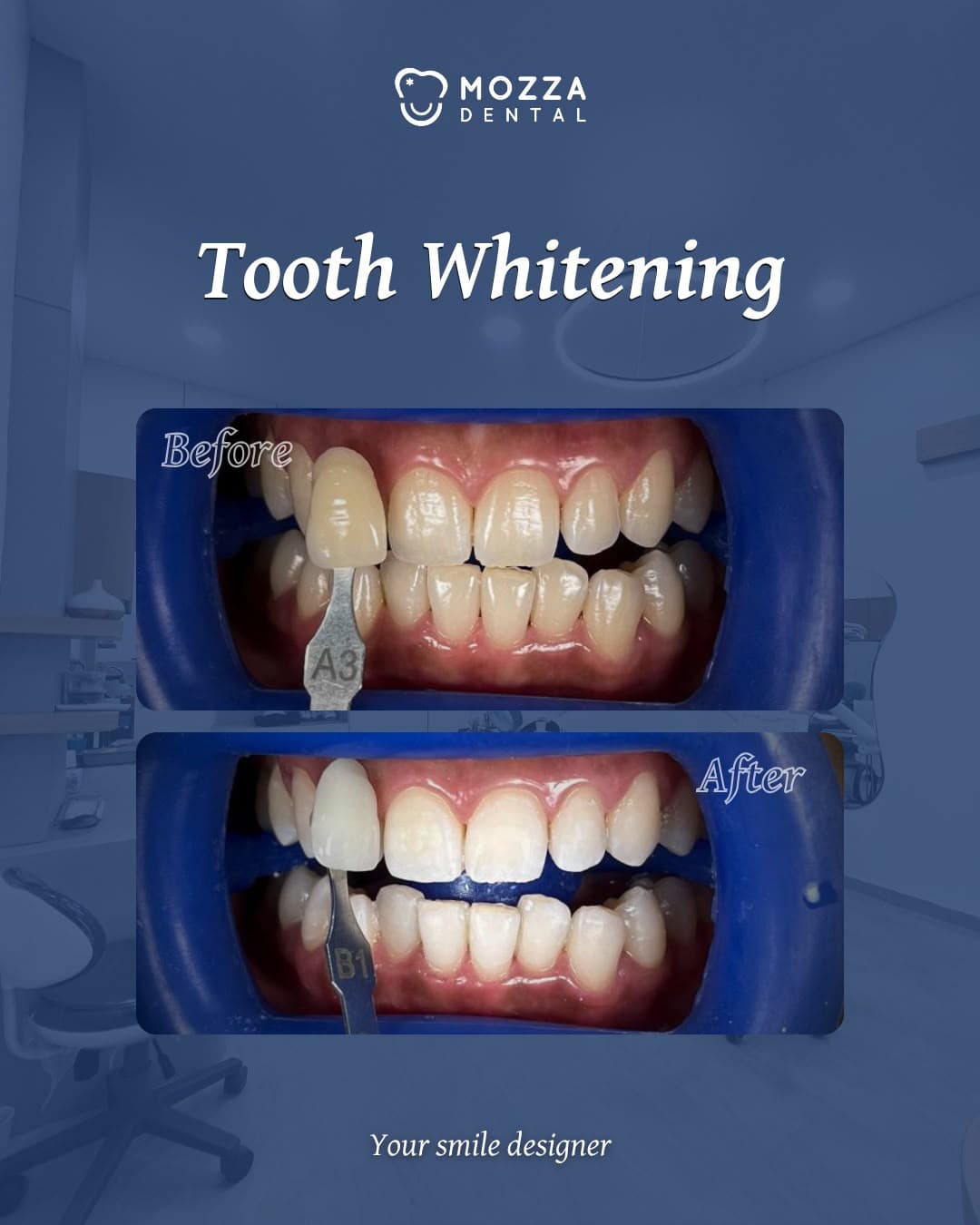 Tooth Whitening (Bleaching)